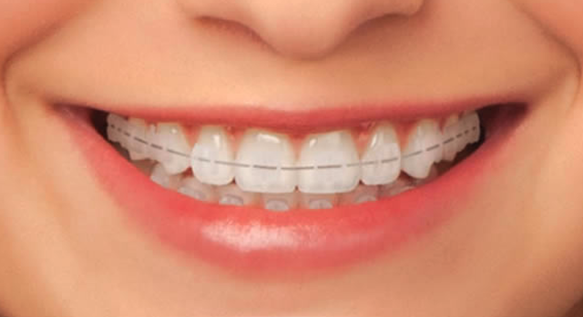 What are the things to take care of after wearing Ceramic braces Singapore