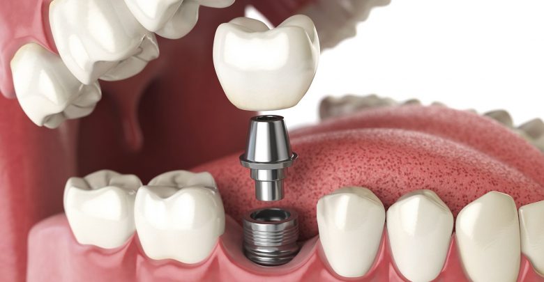 Dental implant Singapore